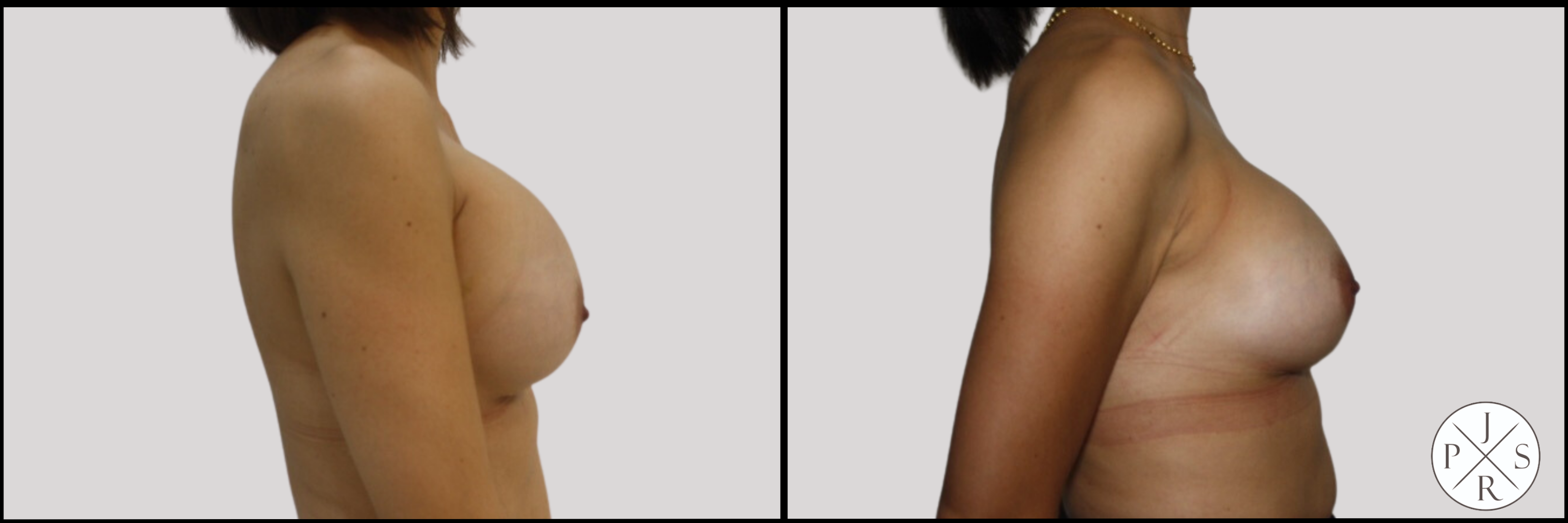 Breast Revision Before & After Image